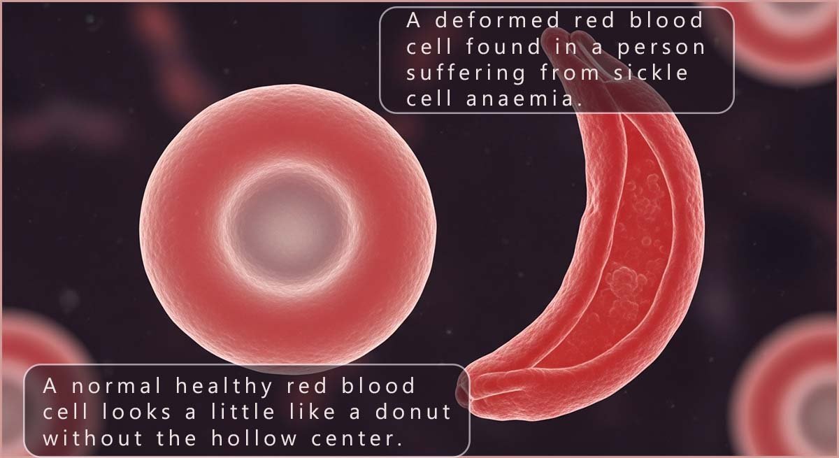 A red blood cell and a sickle red blood cell.